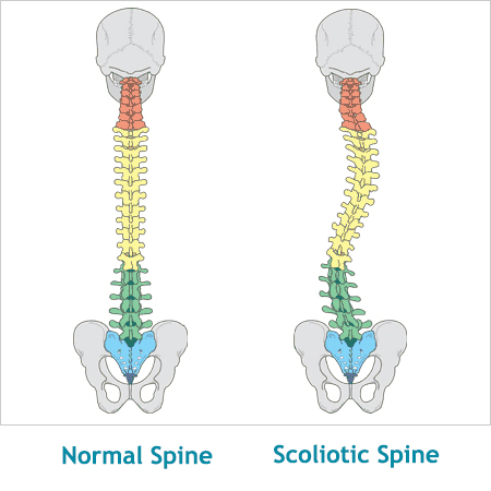 Scoliosis: How Chiropractic Helps a Twisted Spine